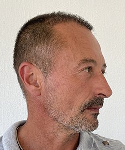 greffe de cheveux après 6 mois nicolas