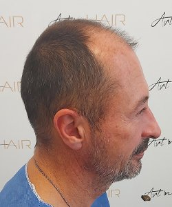 greffe de cheveux avant nicolas