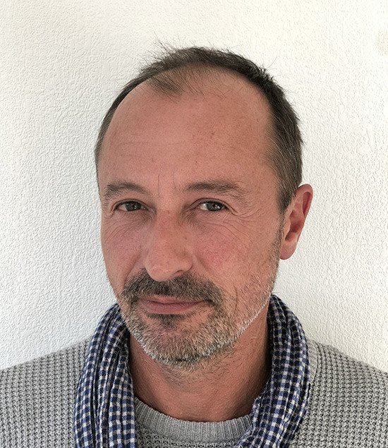 greffe de cheveux nicolas avant