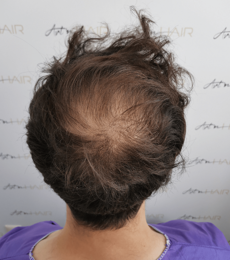 patient avant sa greffe de cheveux