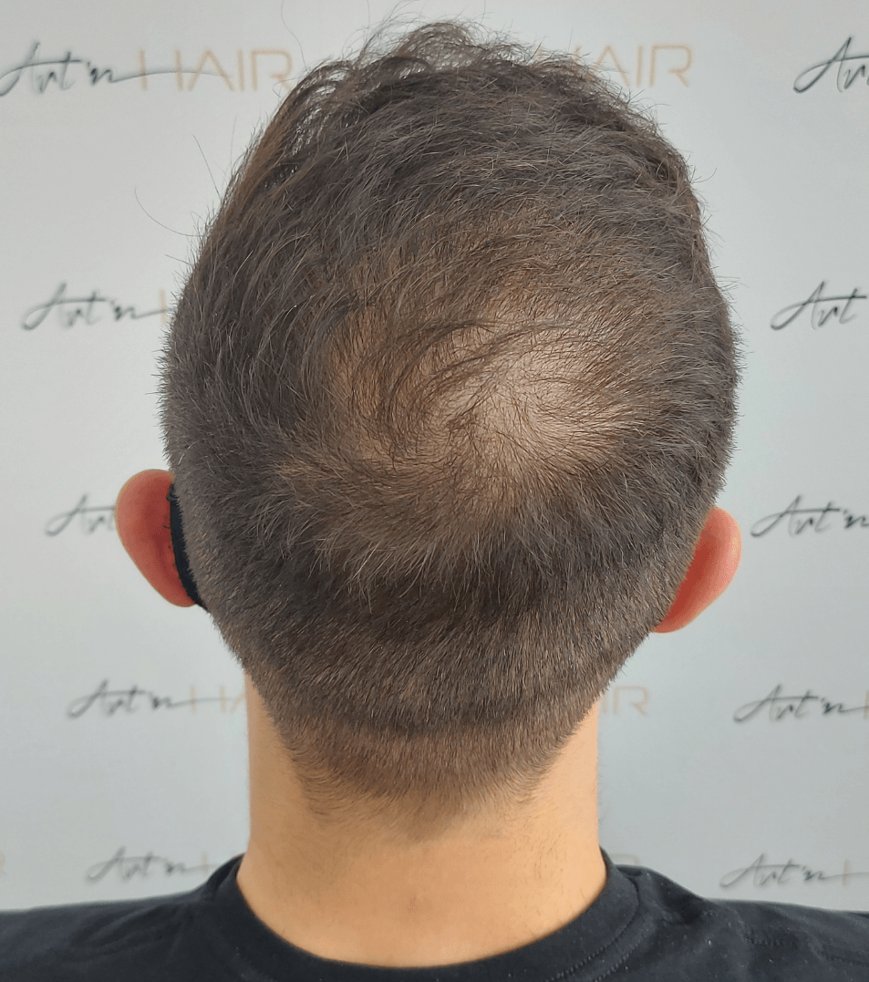 patient 4 mois après sa greffe de cheveux