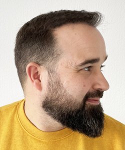 greffe de cheveux après 12 mois david
