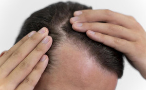 greffe de cheveux pour homme