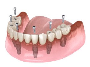 l'implant dentaire all on 6