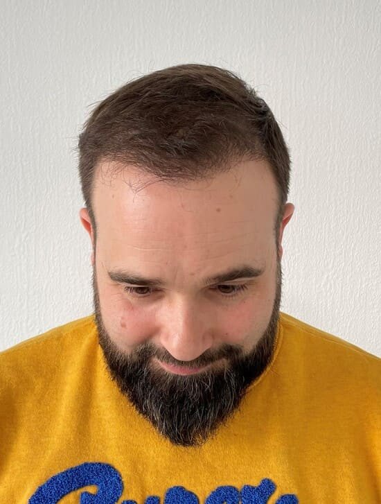 David 6 mois apres sa greffe de cheveux