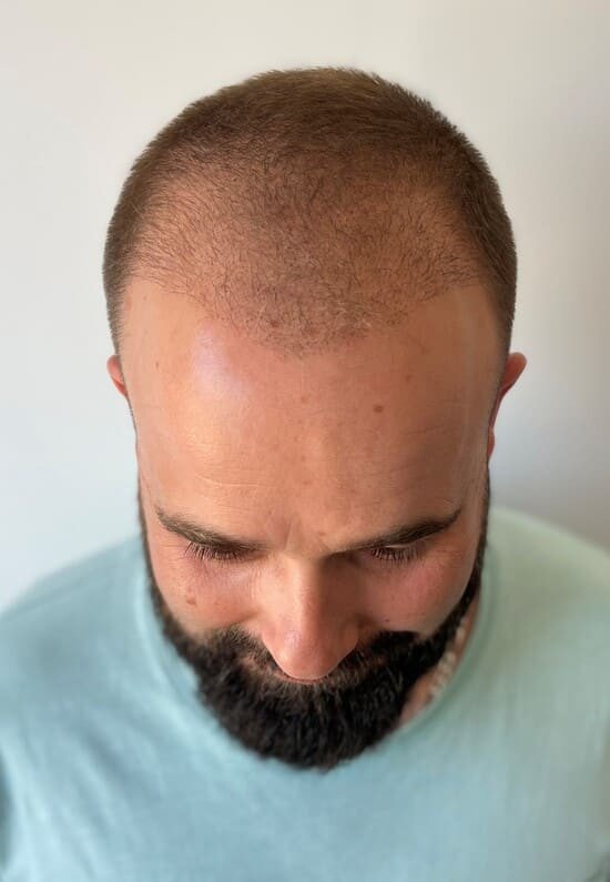 David 1 mois apres sa greffe de cheveux