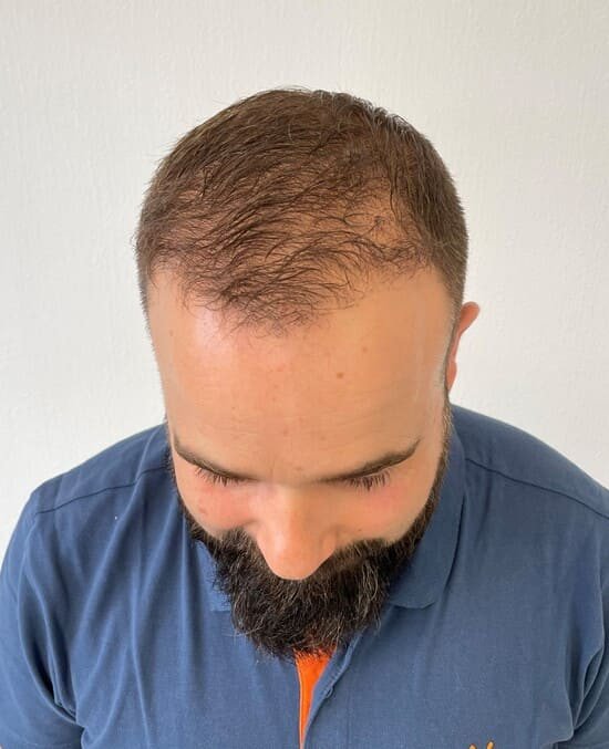 David 3 mois apres sa greffe de cheveux