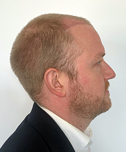 greffe de cheveux fabian après 1 mois