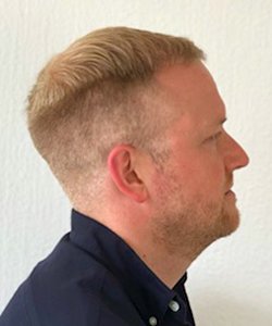 greffe de cheveux fabian après 6 mois