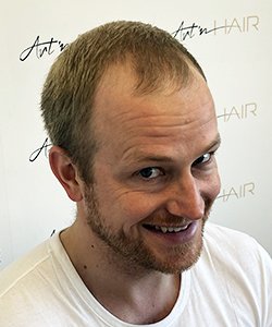 greffe de cheveux avant fabian