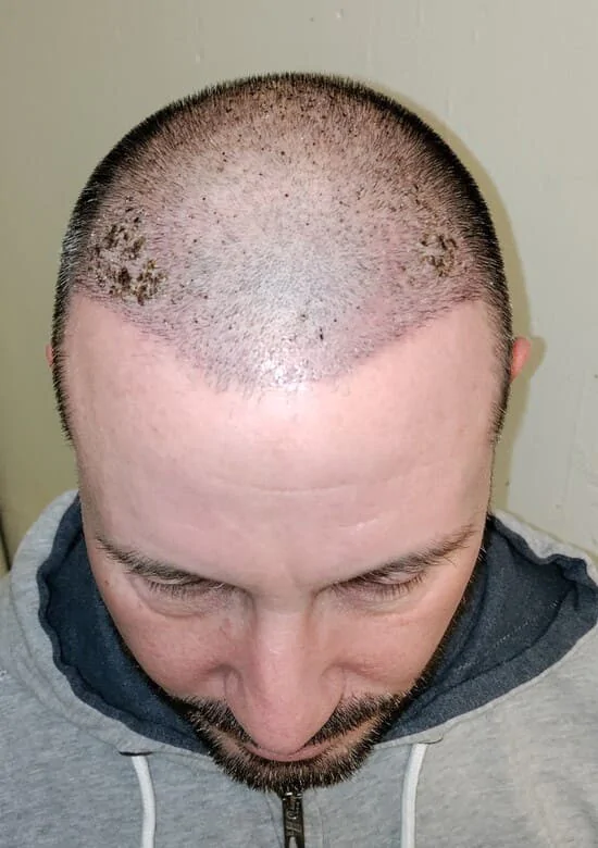 patient apres greffe de cheveux 10 jours