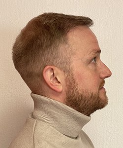 greffe de cheveux fabian après 12 mois