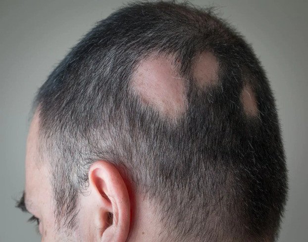 Alopecia Aerata - Calvitie ponctuelle