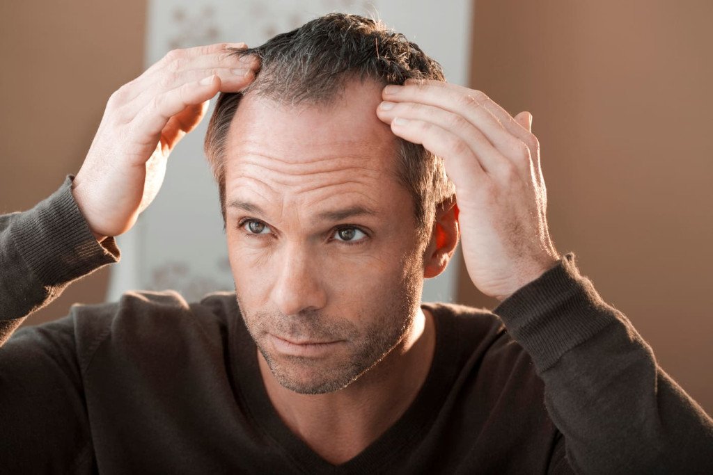 Perte de cheveux, calvitie et pelade : faire la différence - Smile ...