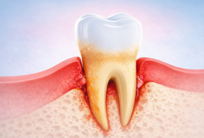 Illustration du déchaussement dentaire