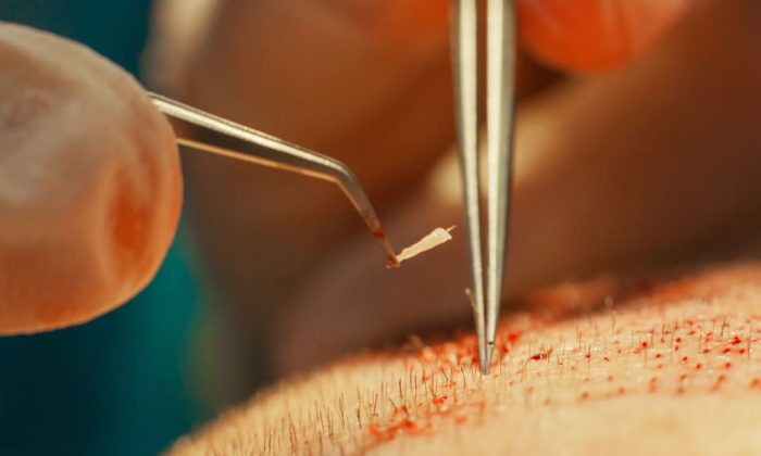 Procédure minutieuse de transplantation de greffons capillaires pour le traitement de la calvitie