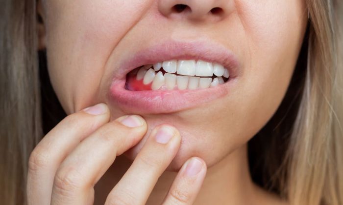 Femme montrant une douleur ou une lésion sur sa gencive inférieure, suggérant une urgence dentaire ou une inflammation des gencives.