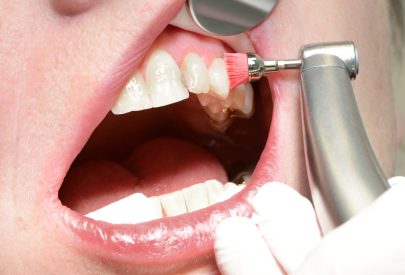 contrôle annuel professionnel des dents avec une brosse à polir par un dentiste en gants blancs.