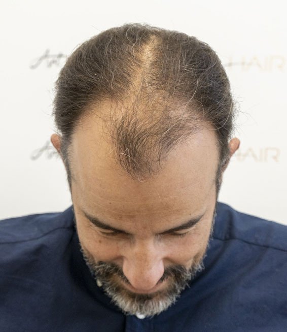 cédric avant sa greffe de cheveux