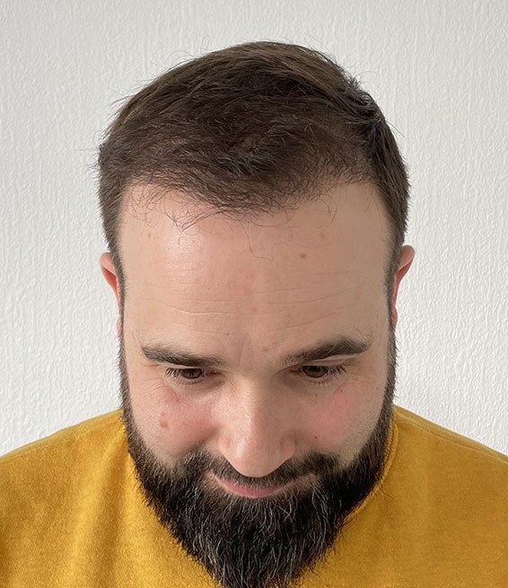 david avant sa greffe de cheveux