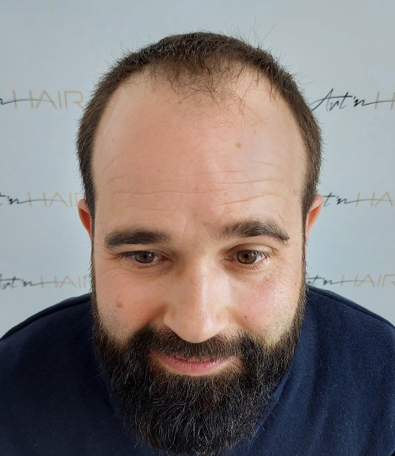 david avant sa greffe de cheveux