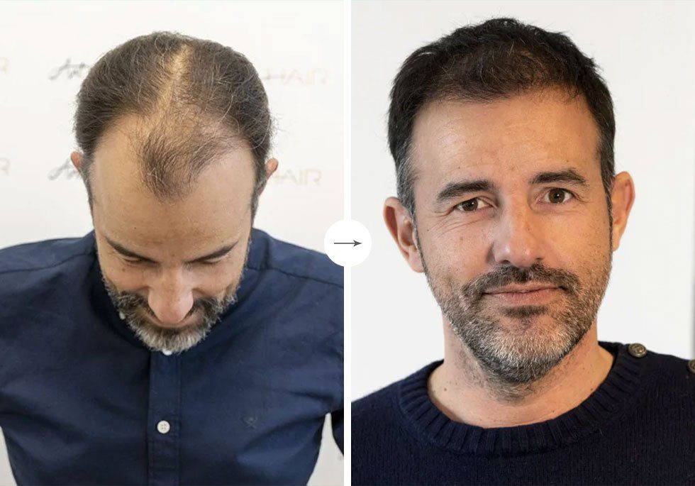 Photos avant après de Cédric suite à sa greffe de cheveux