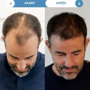 cédric avant et apres greffe de cheveux