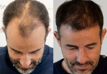 cédric avant et apres greffe de cheveux