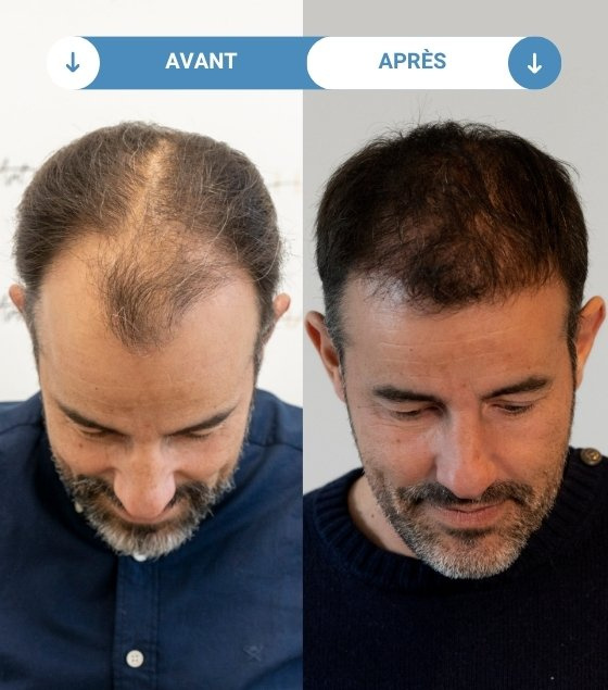 cédric avant et apres greffe de cheveux