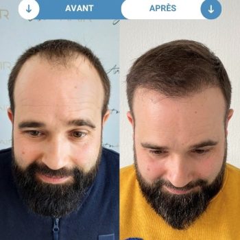 david avant et apres greffe de cheveux