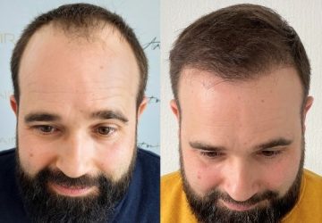 david avant et apres greffe de cheveux
