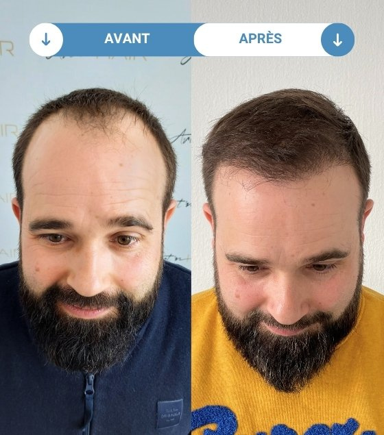 david avant et apres greffe de cheveux