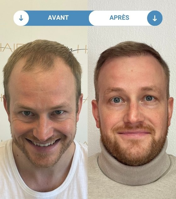 fabian avant et apres greffe de cheveux
