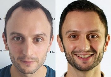 guillaume avant et apres greffe de cheveux
