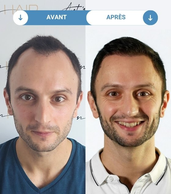 guillaume avant et apres greffe de cheveux