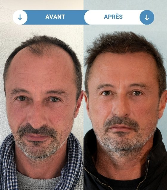 nicolas avant et apres greffe de cheveux