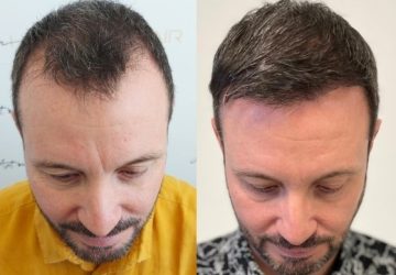 jérôme avant et apres greffe de cheveux