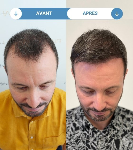 jérôme avant et apres greffe de cheveux