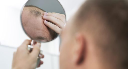 Homme qui a des problèmes de calvitie et pense à une solution de greffe de cheveux