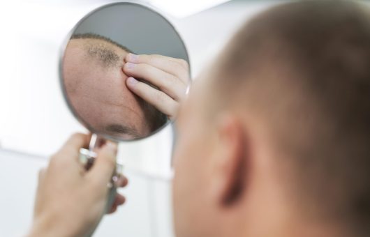 Homme qui a des problèmes de calvitie et pense à une solution de greffe de cheveux