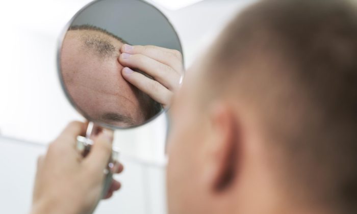 Homme qui a des problèmes de calvitie et pense à une solution de greffe de cheveux