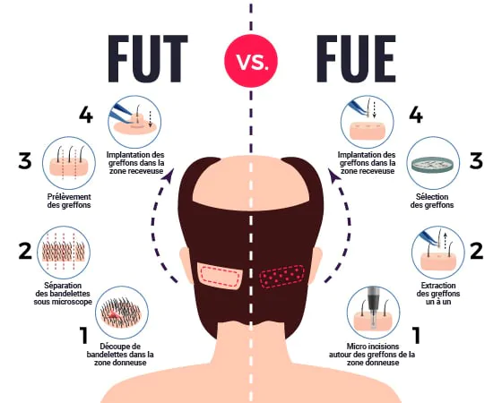 greffe de cheveux FUE vs greffe de cheveux FUT différences
