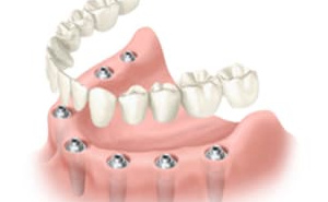 Prothèse complète dentaire fixe sur implants