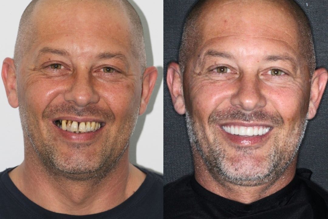 avant après julien