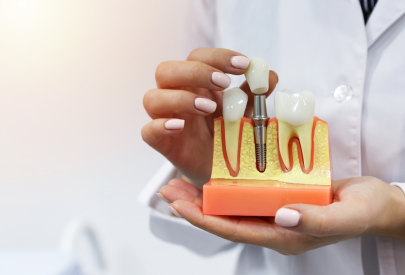illustration d'un implant, entre deux dents saines