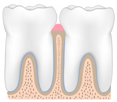 image de deux dents en stade de parodontite légère (gencive rosée)