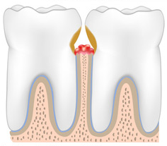 image de deux dents en stade de parodontite avancée (gencive qui se rétracte et espace entre les dents)