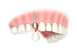 couronne dentaire en zircone