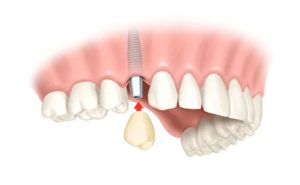 couronne dentaire zircone monolithique