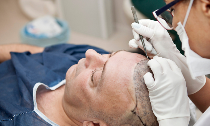 homme qui se fait une greffe de cheveux sous anesthesie locale